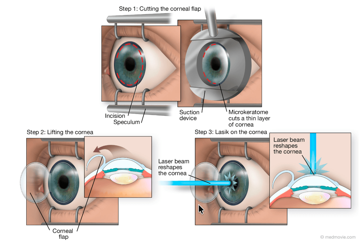 What is a Cataract โ eye lens diagram